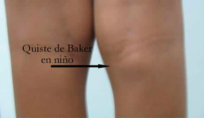 quiste de baker ni&ntilde;o