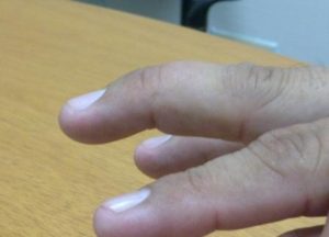 DEDO EN MARTILLO DE LA MANO - TUTRAUMATOLOGO.COM